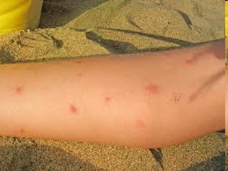 Las autoridades venezolanas dijeron hoy que han confirmado 788 casos del virus chikungunya en el...