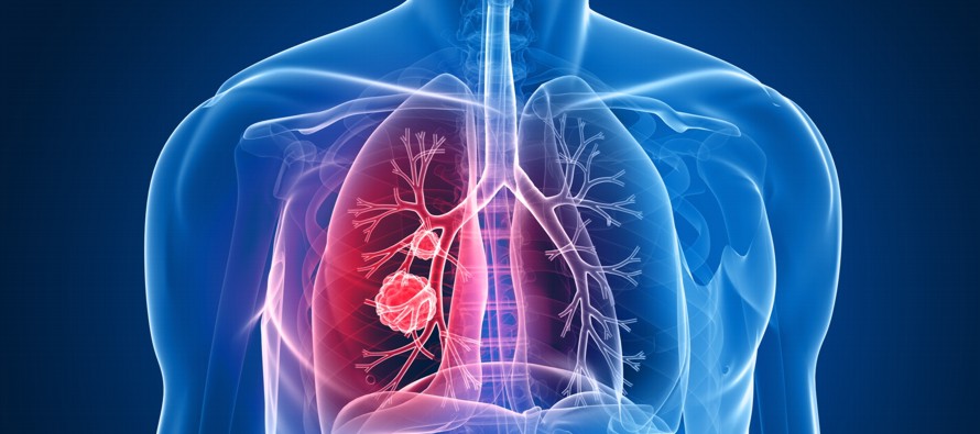 El cáncer de pulmón es la causa de 1,7 millones de fallecimientos anuales en el...