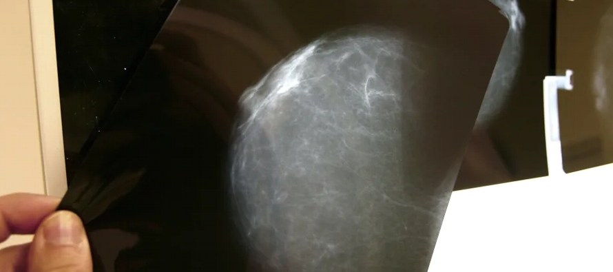 Los investigadores señalan que hasta un tercio de los casos de cáncer de mama...
