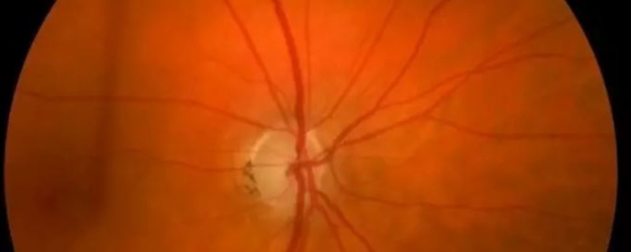 El glaucoma es la principal causa mundial de ceguera irreversible y afecta a más de 60...