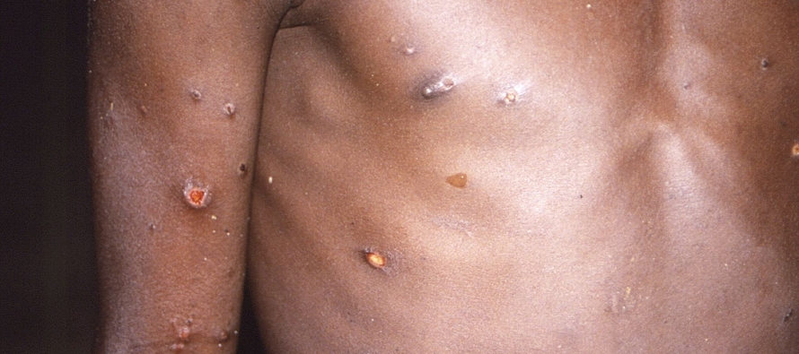 La Organización Mundial de Salud ha reportado casi 200 casos de viruela símica en...